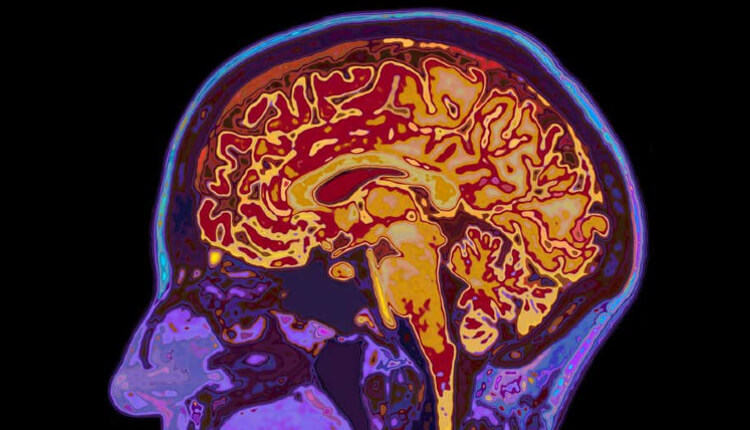 تصویر MRI از مغز که می‌تواند چند درجه گرم‌تر از بقیه بدن باشد