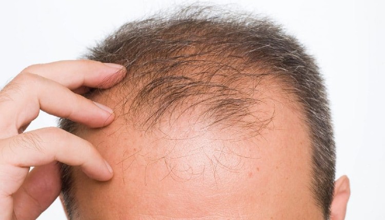 مولکولی جدید برای درمان ریزش موی وابسته به هورمون مردانه یا آلوپسی آندروژنتیک که رشد مو را به‌شدت تحریک می‌کند