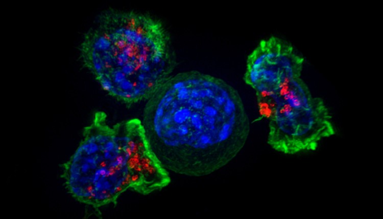 سلولی سرطانی در محاصره سلول‌های T کشنده